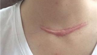 糖皮质激素的抗炎作用机制图解,糖皮质激素可以抗休克吗