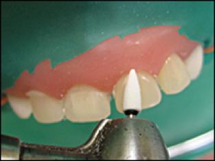 乳前牙预成冠补牙过程,乳前牙龋坏修复