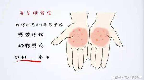 大肠癌化疗后抽血注意事项,大肠癌化疗完手无血色是咋回事