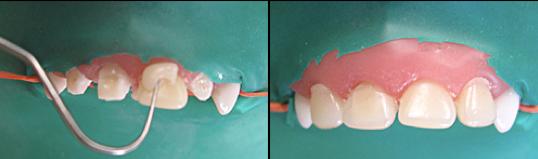 前牙光固化美容修复的方法,乳前牙预成冠修复过程