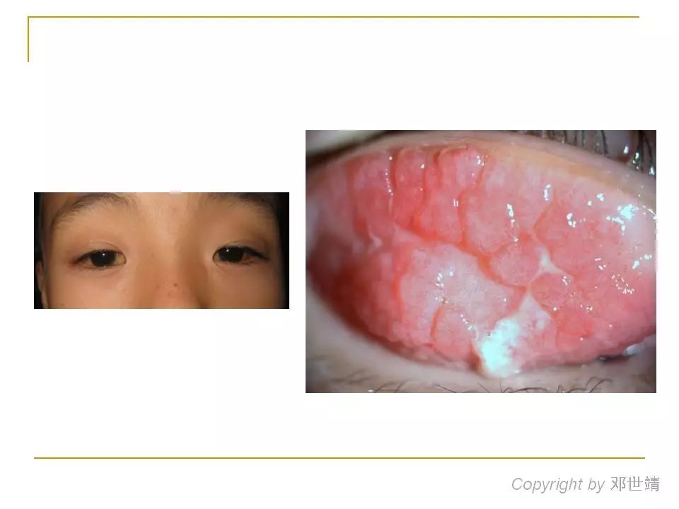 眼周过敏中医治疗,眼周过敏的症状图片