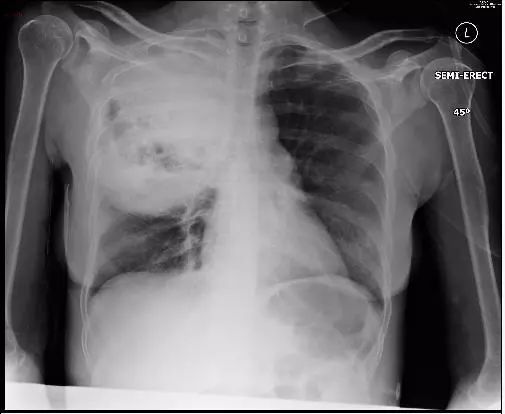 如何通过肺ct看出自己得了肺炎,肺ct怎么看出是病毒还是细菌