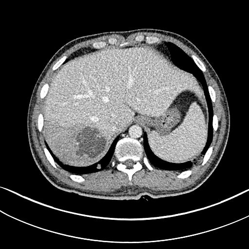 如何通过肺ct看出自己得了肺炎,肺ct怎么看出是病毒还是细菌