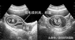 助你好孕,孕早期肚子隐隐作痛出血