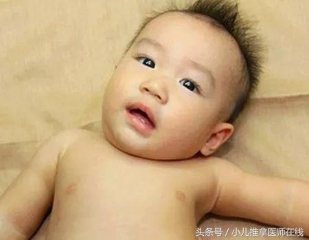 哈尔滨小儿推拿斜颈哪个地方好,小儿斜颈推拿的治愈率有多高