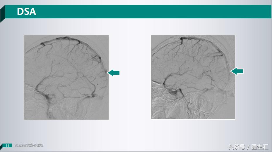 各项检查正常总感觉自己有病,轻度意识障碍是什么