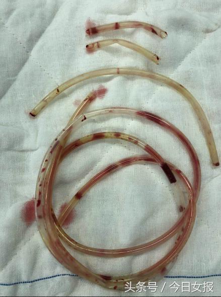 男性尿道进异物后果,膀胱内异物进入尿道