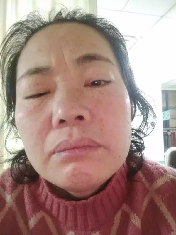 重症肌无力和神经损失哪个严重,重症肌无力晚年