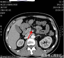 呕吐出褐色的液体,呕吐出咖啡色絮状物需要去医院吗