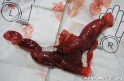 孕妈生二胎早产14天得知是三胞胎,一胎单胎顺产二胎双胞胎