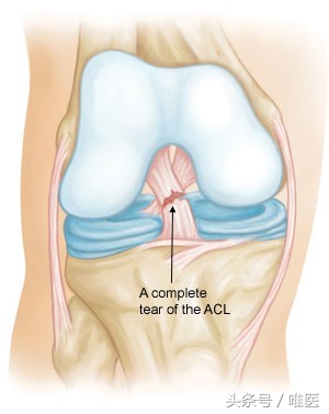 韧带损伤科普视频,前交叉韧带损伤运动康复科普视频