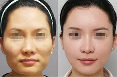 自体脂肪填充川字纹保持多久,自体脂肪填充10天内效果图