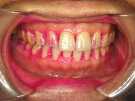 过年牙龈肿痛怎么办,食物残渣造成的牙龈肿痛怎么办