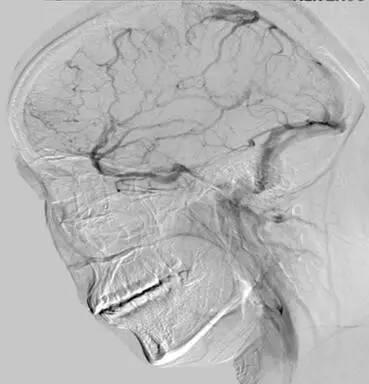 颅内静脉窦血栓ct特征,颅内静脉窦血栓的定性诊断