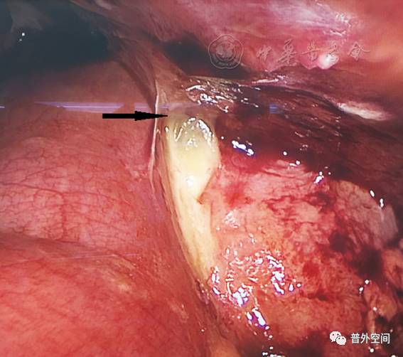结肠癌术后吻合口瘘的表现和处理,结肠癌术后吻合口瘘腹膜炎