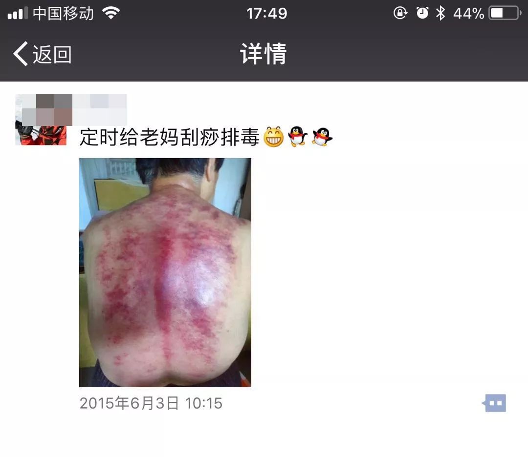 阿娇刮痧后背效果,阿娇背部刮痧图片