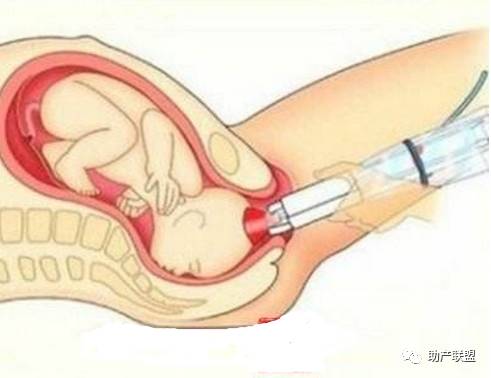 分娩适宜技术,各种分娩方法