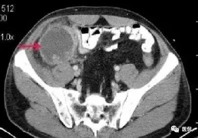 阑尾的解剖和影像表现,阑尾炎的32种鉴别诊断