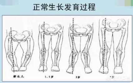 宝宝罗圈腿是天生的么,宝宝罗圈腿是什么原因引起的