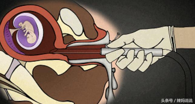 子宫内有残留物影响后期怀孕吗,女子体检发现没有子宫