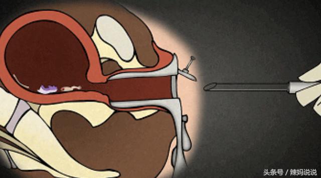 子宫内有残留物影响后期怀孕吗,女子体检发现没有子宫