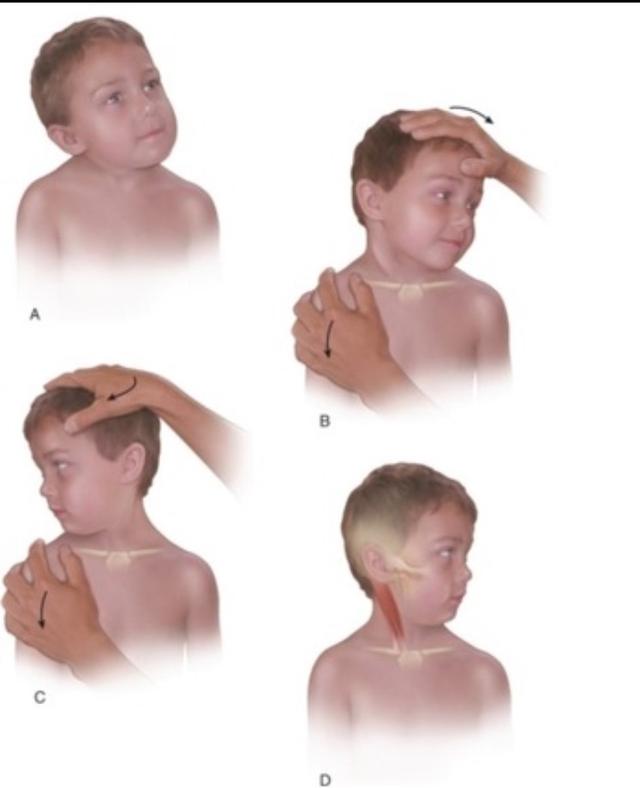 小儿推拿斜颈穴位有哪些,小儿斜颈推拿视频教程