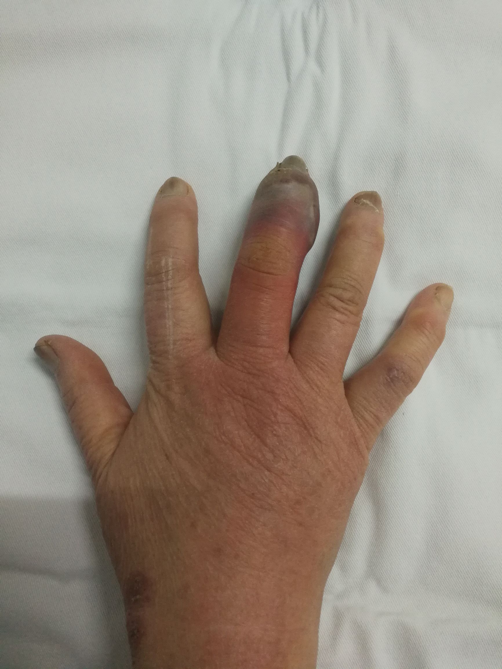 糖尿病要截掉手指是什么情况,糖尿病手指截掉是怎么回事