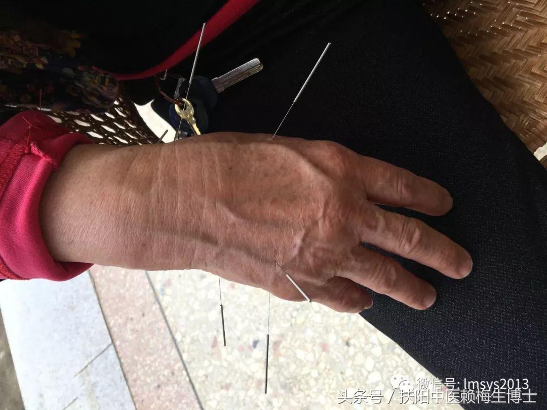 内针治疗带状疱疹剧烈疼痛4例分析