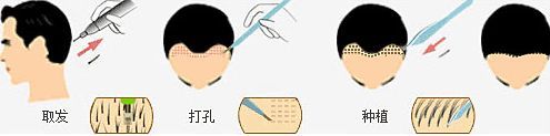 毛发种植有哪些风险,体毛种植后的效果