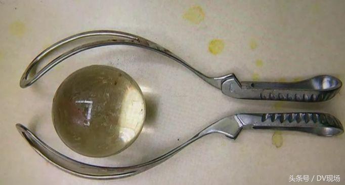 东莞男子肛门塞进直径8厘米玻璃球，紧急就医！