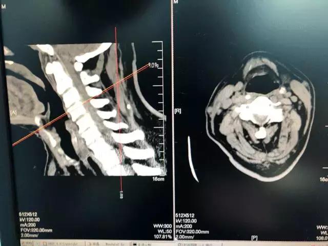 老人腰椎间盘突出需要微创手术吗,老人颈椎突出挺厉害能复位吗