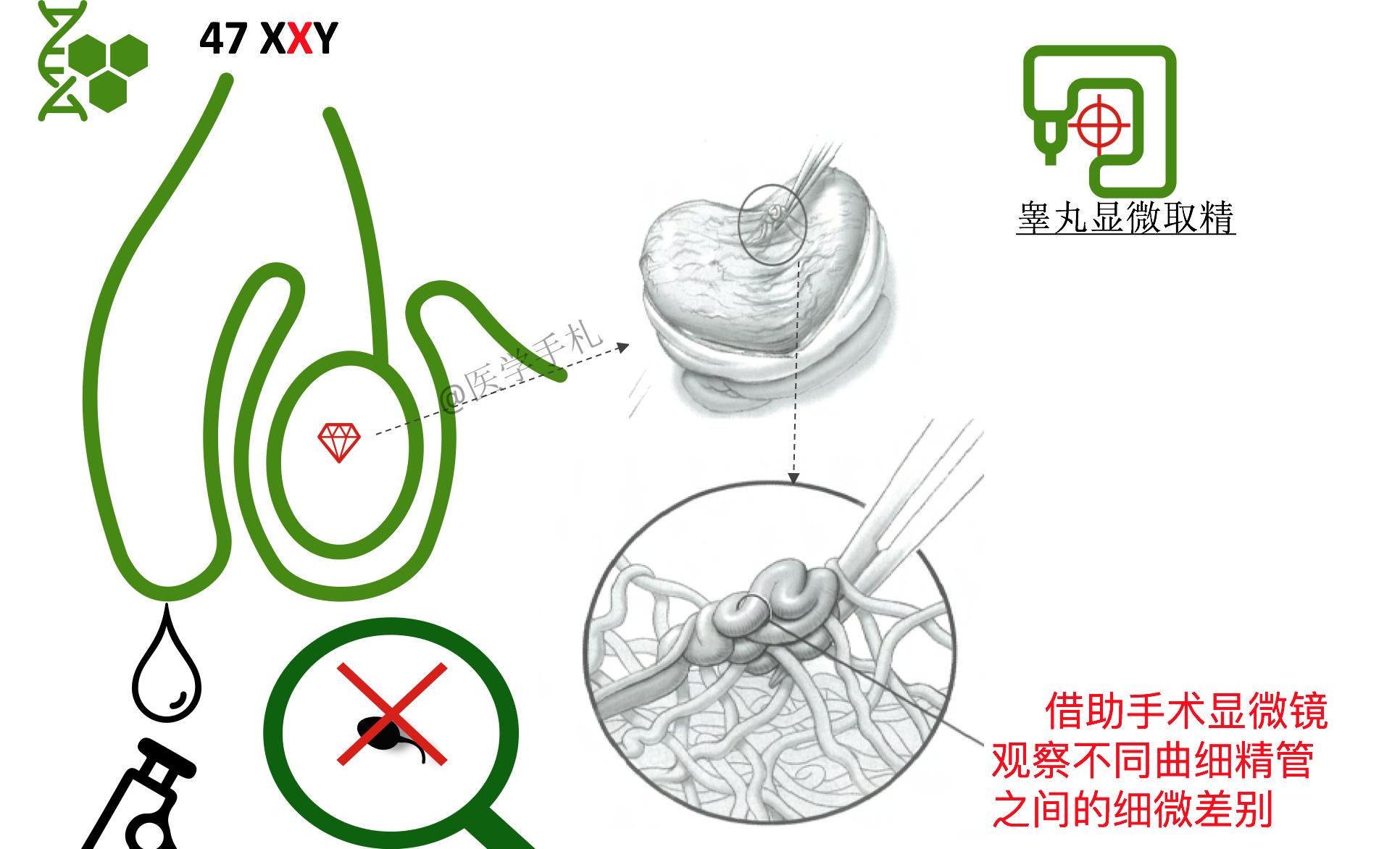 克氏综合征的人染色体会缺失吗,克氏综合征是染色体多吗