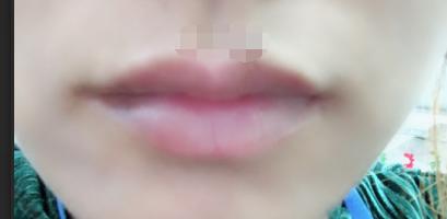 怎么才能消除唇炎,唇炎怎么快速消除小窍门视频