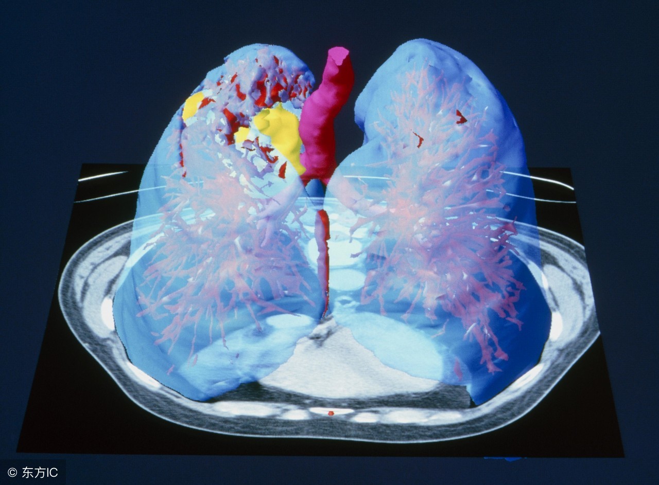 肺癌晚期可能出现哪些转移症状,小细胞肺癌晚期转移死前症状