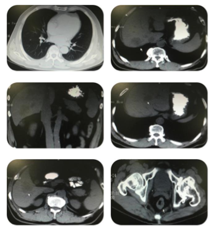 直肠癌肺转移多发治疗方案,直肠癌转移治愈病例