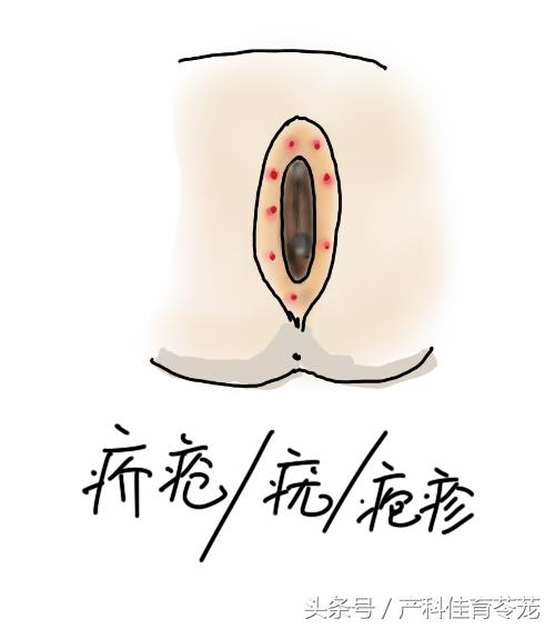 外阴瘙痒骚味重用什么药,外阴瘙痒可以自愈吗