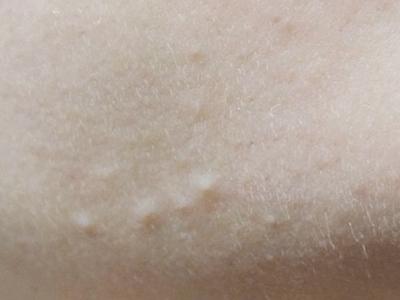 白头粉刺和闭口粉刺的治疗方法,白头粉刺闭口引起的原因