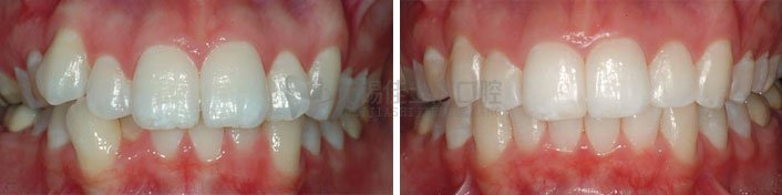 牙齿拥挤怎么矫正牙齿,牙齿拥挤矫正方法