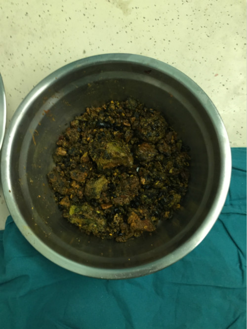 胆结石34年没治好,东莞98岁老人取胆结石