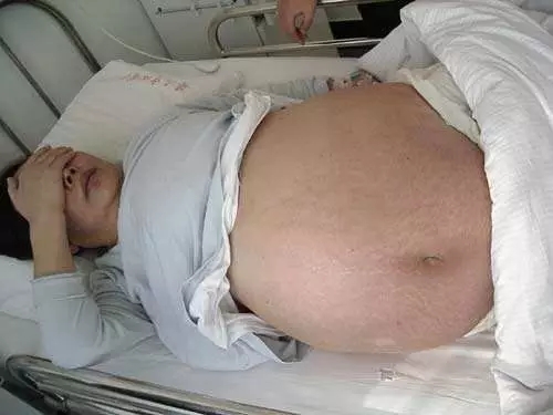 肝血管瘤临床诊疗指南最新版,肝血管瘤10mm没有任何症状