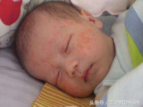 关于宝宝湿疹，宝妈一定要知道的