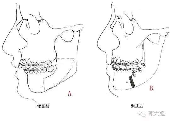 第一次整容日记,整容日记最经典的一段