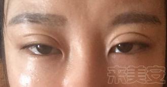 平行双眼皮割成了欧式双眼皮,割了个欧式双眼皮