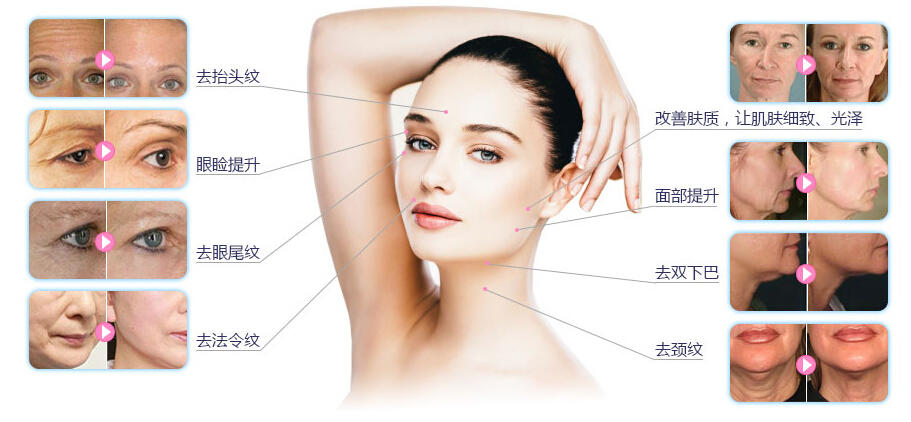 超声刀抗衰老真的有那么神奇吗,超声刀真的能抗老