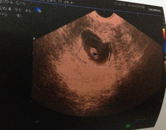 孕妈b超单怎么看,如何看懂b超影像里哪个是胎儿