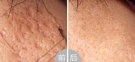 脸上有痘印痘坑怎么去修复,脸上痘坑凹洞怎么修复