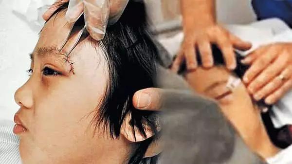 儿童眼病筛查中最常用的检查方法,检查幼儿眼睛近视的方法