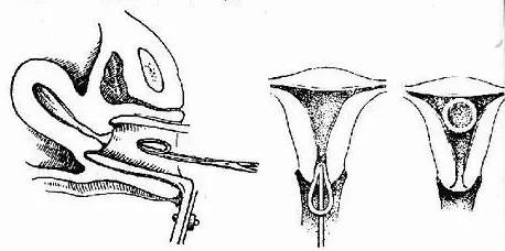 女性上环对血压有影响吗,女性上环前需要注意什么