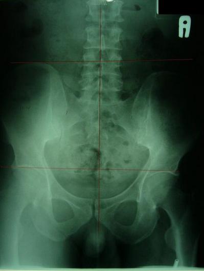 屁股歪了,屁股歪了最佳治疗方法