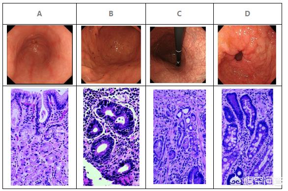 胃镜肠上皮化生是怎么回事,胃镜提示上皮肠化